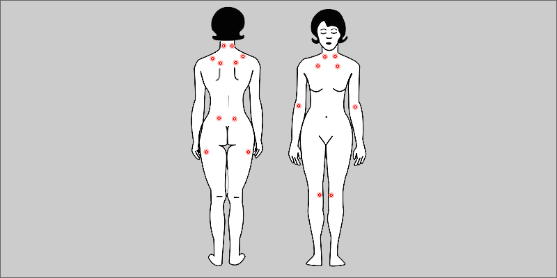 points Fibromyalgia: Is Marijuana The Best Treatment?