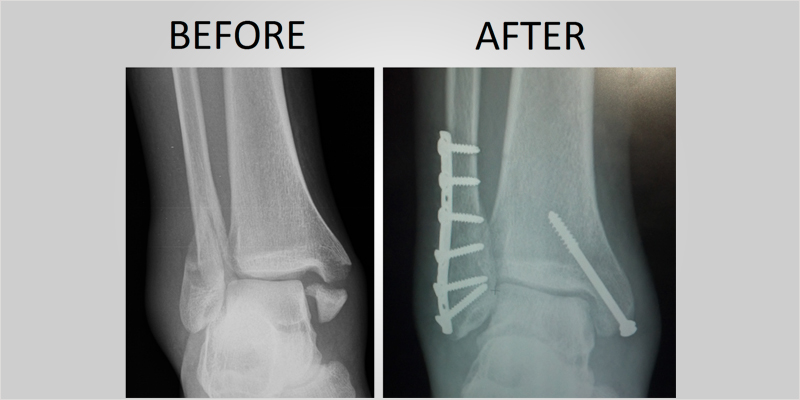 no bones ci 8 No Bones About It: How Cannabis May Combat Bone Diseases