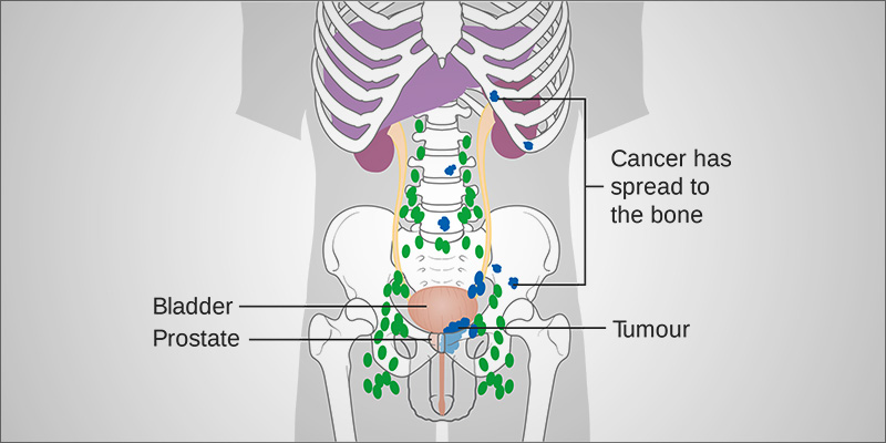 Prostate Cancer The 2 photo Prostate Cancer The 2 Prostate Cancer: The Evidence For Medical Cannabis