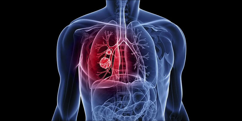 What Does Weed 4 1 photo What Does Weed 4 1 What Does Smoking Weed Do To Your Lungs?