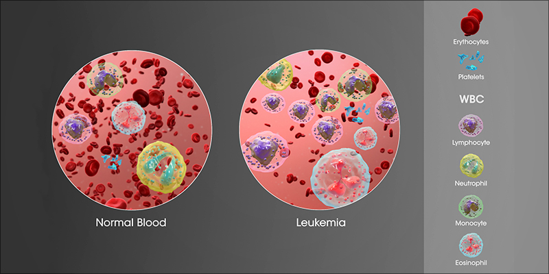 Is Cannabis Effective 1 Is Cannabis Effective Against Leukemia?