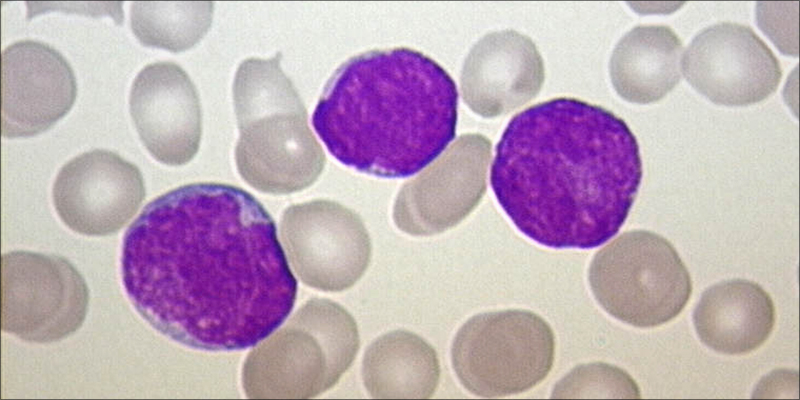 Is Cannabis Effective 5 Is Cannabis Effective Against Leukemia?